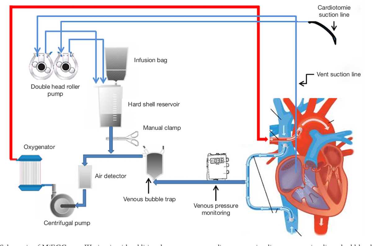 heart lung machine circuit diagram heart lung machine circuit diagram