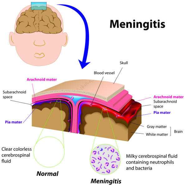 pathophysiology of meningitis schematic diagram