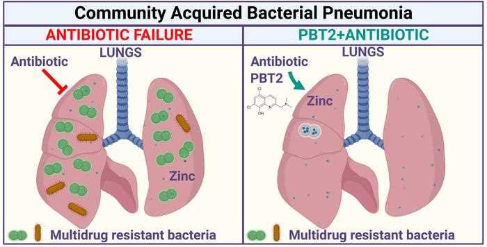 schematic diagram of pneumonia
