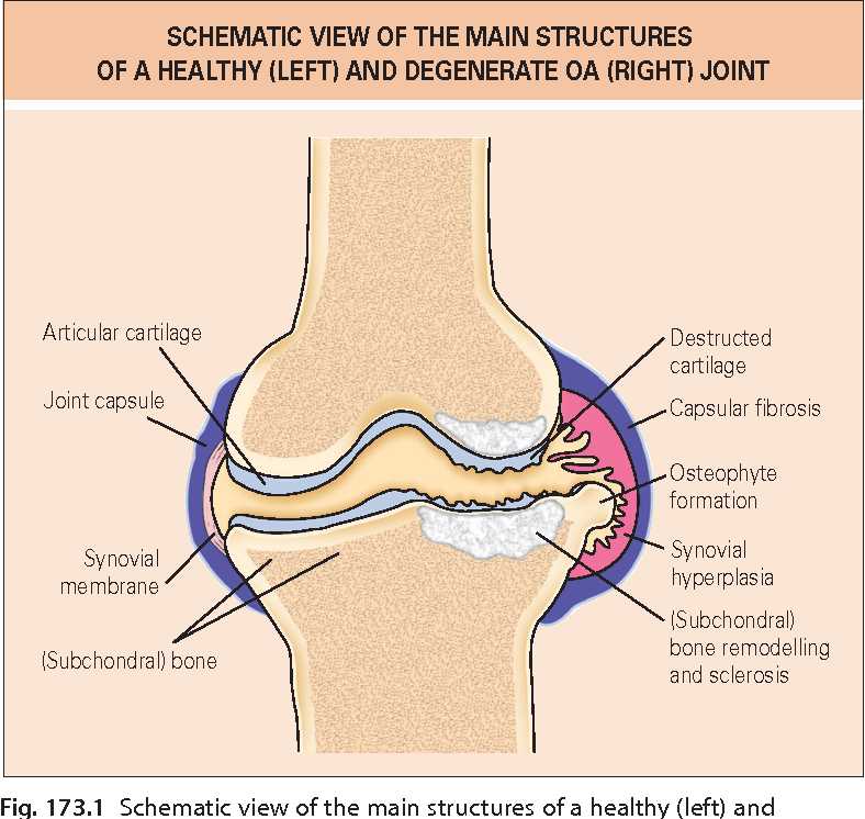 pathophysiology of osteoarthritis schematic diagram pathophysiology of osteoarthritis schematic diagram