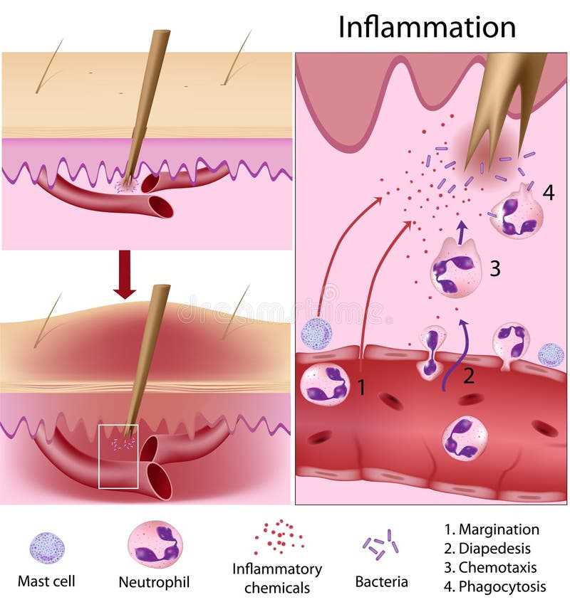 inflammatory process schematic diagram