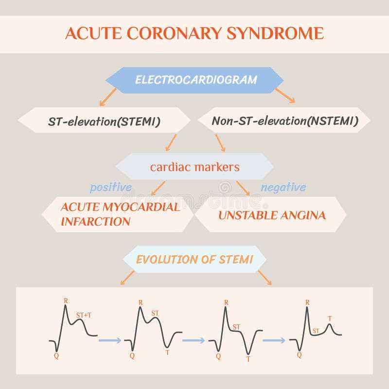 pathophysiology of myocardial infarction with schematic diagram
