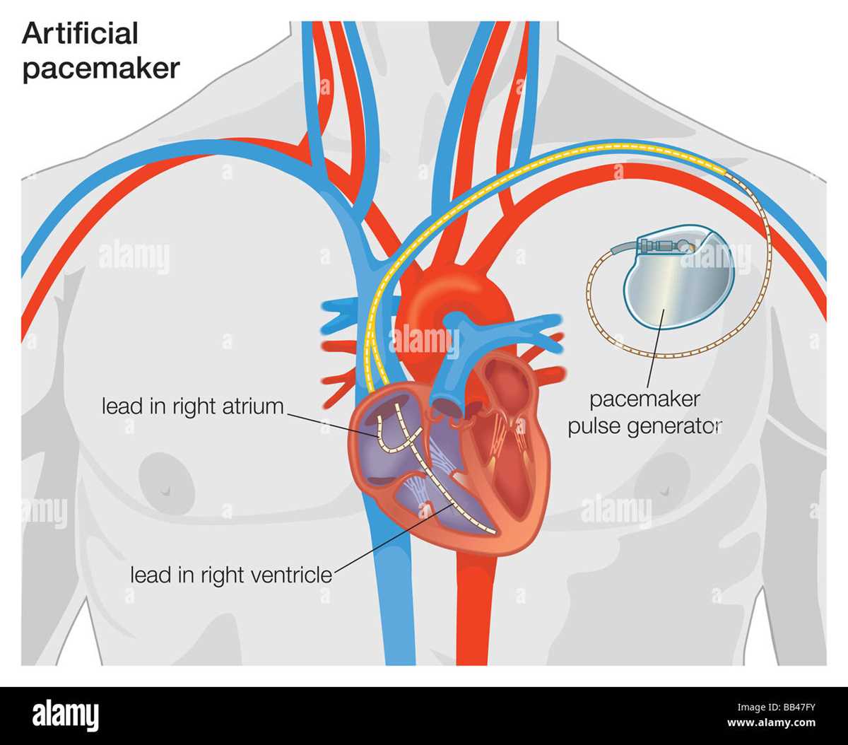 pacemaker schematic diagram