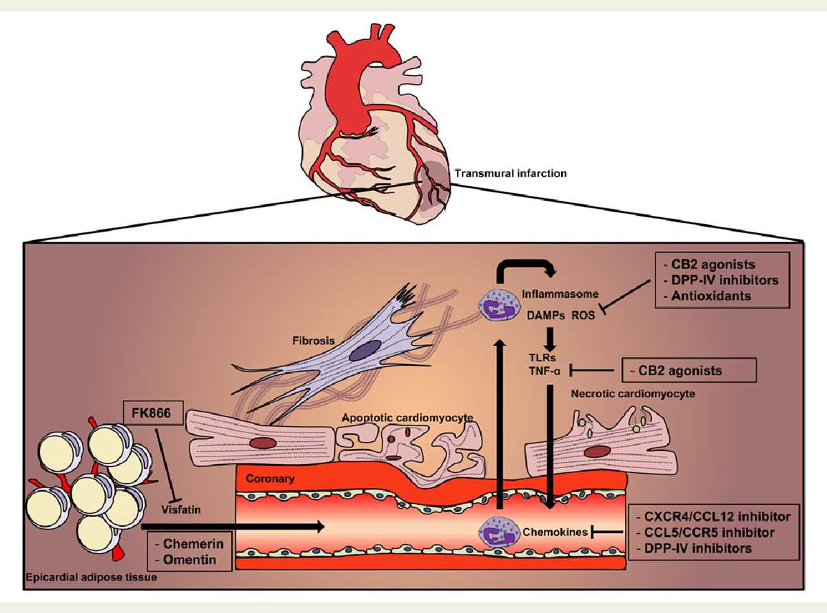 pathophysiology of myocardial infarction with schematic diagram