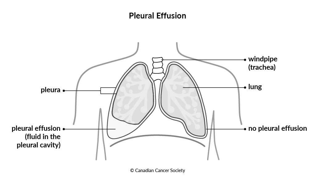 pathophysiology of pleural effusion schematic diagram pathophysiology of pleural effusion schematic diagram