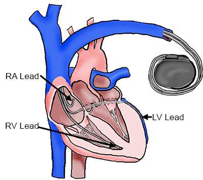schematic diagram of coronary circulation