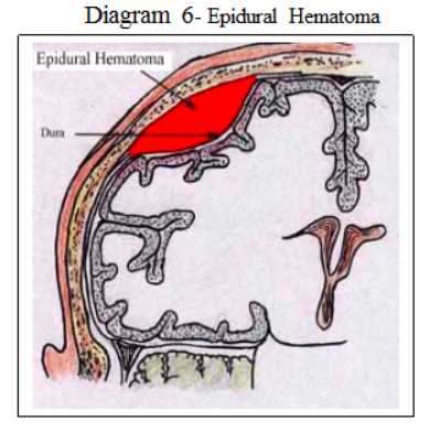 schematic diagram of head injury