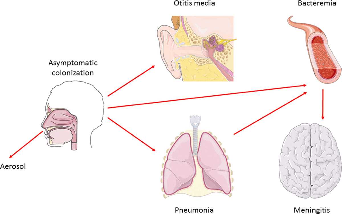 schematic diagram of pneumonia