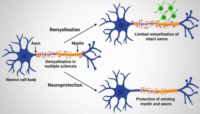 schematic diagram pathophysiology multiple sclerosis