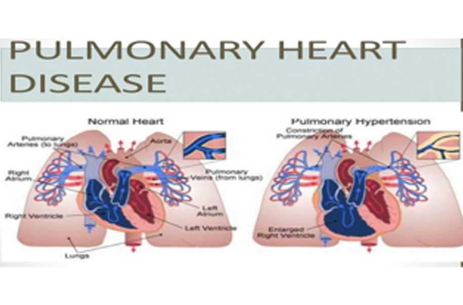 cor pulmonale pathophysiology schematic diagram