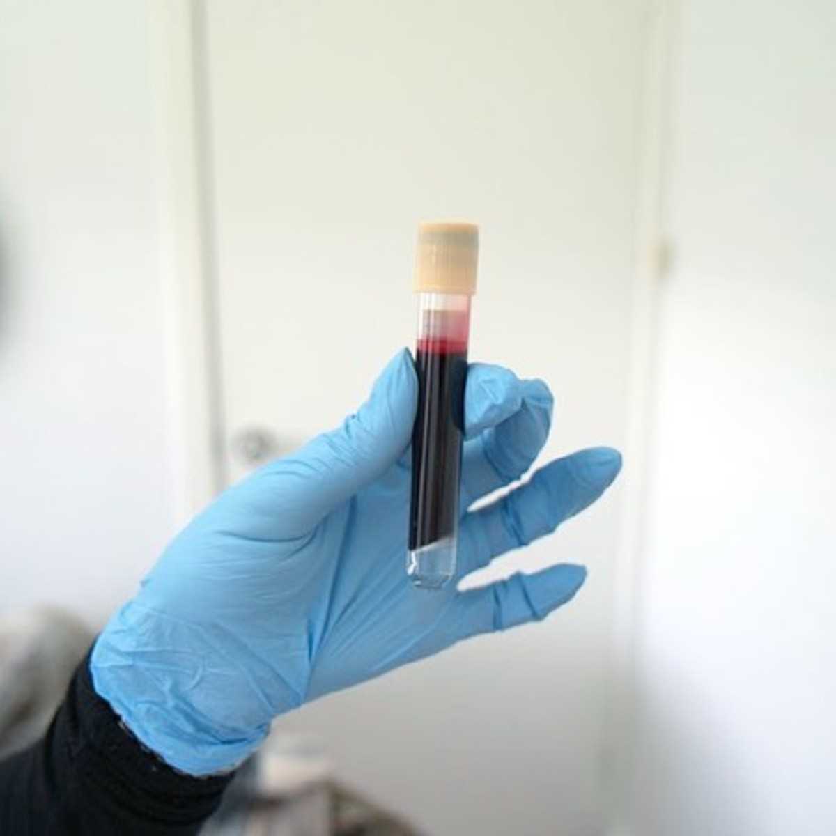 schematic diagram transferring serum plasma specimen laboratory test schematic diagram transferring serum plasma specimen laboratory test
